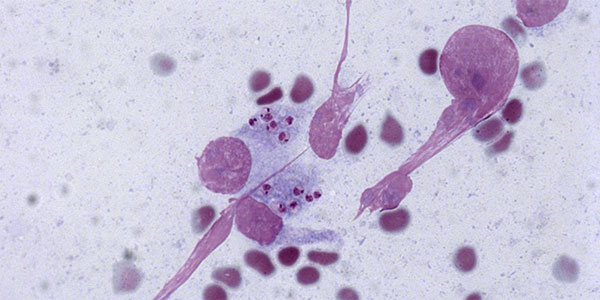 Image credit: Gulab Rani. Intracellular (amastigote) form of the Leishmania donovani parasite (small dark pink blobs) inside macrophages (larger pink and light blue cells), the immune cells responsible for detecting, engulfing and destroying pathogens and dying cells, but which become the ‘hiding place’ for the parasite during chronic infection.
